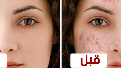 5 طرق لعلاج حبوب الوجه بعد إزالة الشعر 6 383648379543462